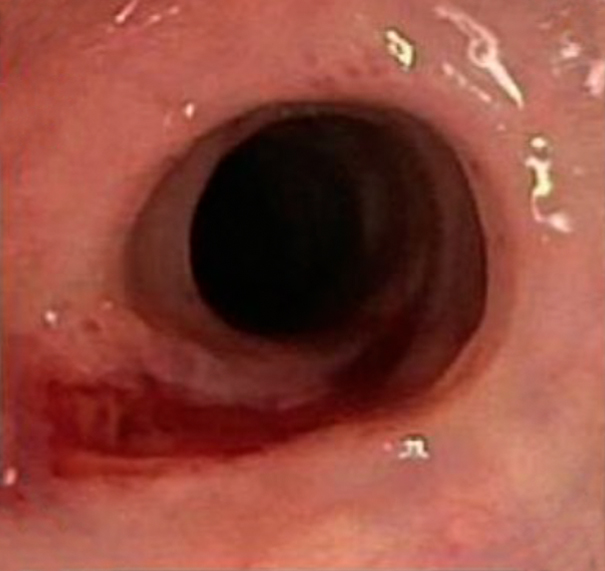 Endoskopische Dilatation Bild 2